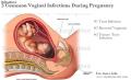 عفونت در بارداری