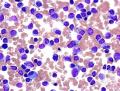 لوسمی لنفوسیتی یا سرطان خون چیست؟