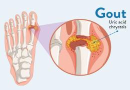 افزایش سطح اسید اوریک و بیماری نقرس(gout)