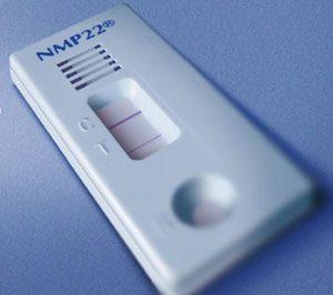 NMP22 جایگزینی مناسب برای سیتولوژی ادرار