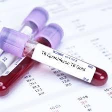 کوآنتی فرون طلایی (QFT-TB Gold) تستی نوین در تشخیص سل نهفته