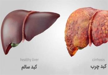 ارزش تشخیصی آزمایش های کبدی در تشخیص کبد چرب (Fatty liver diagnosis)