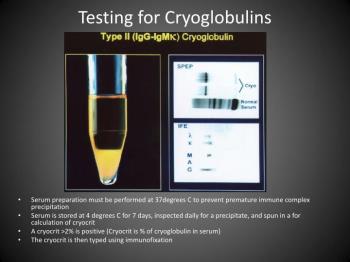 انجام صحیح آزمایش Cryoglobulin بر اساس روش دستی