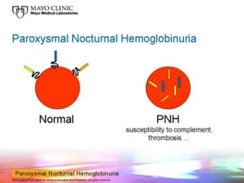 فلوسایتومتری برای تشخیص PNH (هموگلوبینوری حمله ای شبانه)
