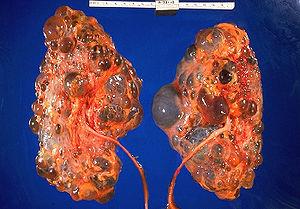 بیماری کلیه پلی کیستیک Polycystic kidney disease syndrome؛ PKD) ) چیست؟