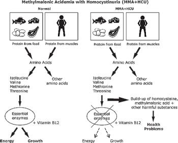 اختلالات متابولیک اسید های اُرگانیک: Methylmalonic Acidemia with Homocystinuria