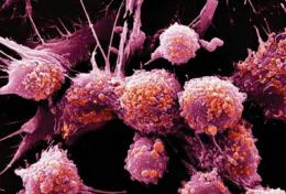 Low Testosterone Men Less Likely to Have Prostate Cancer